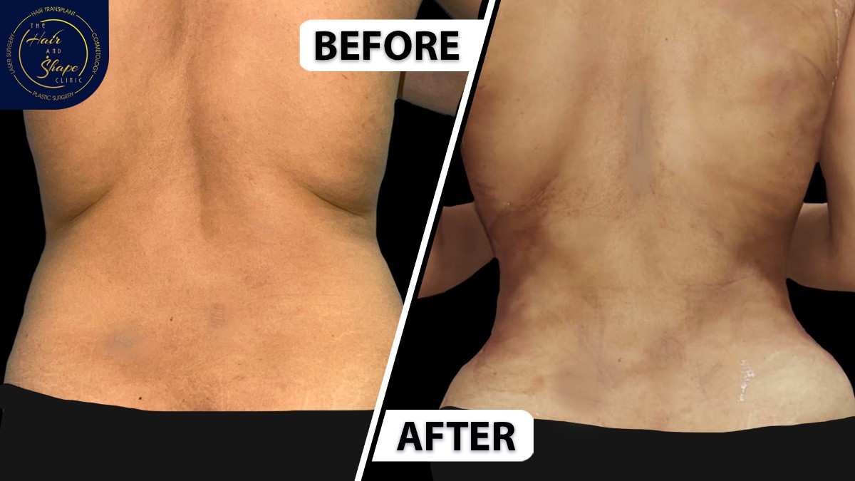 Back Liposuction result11
